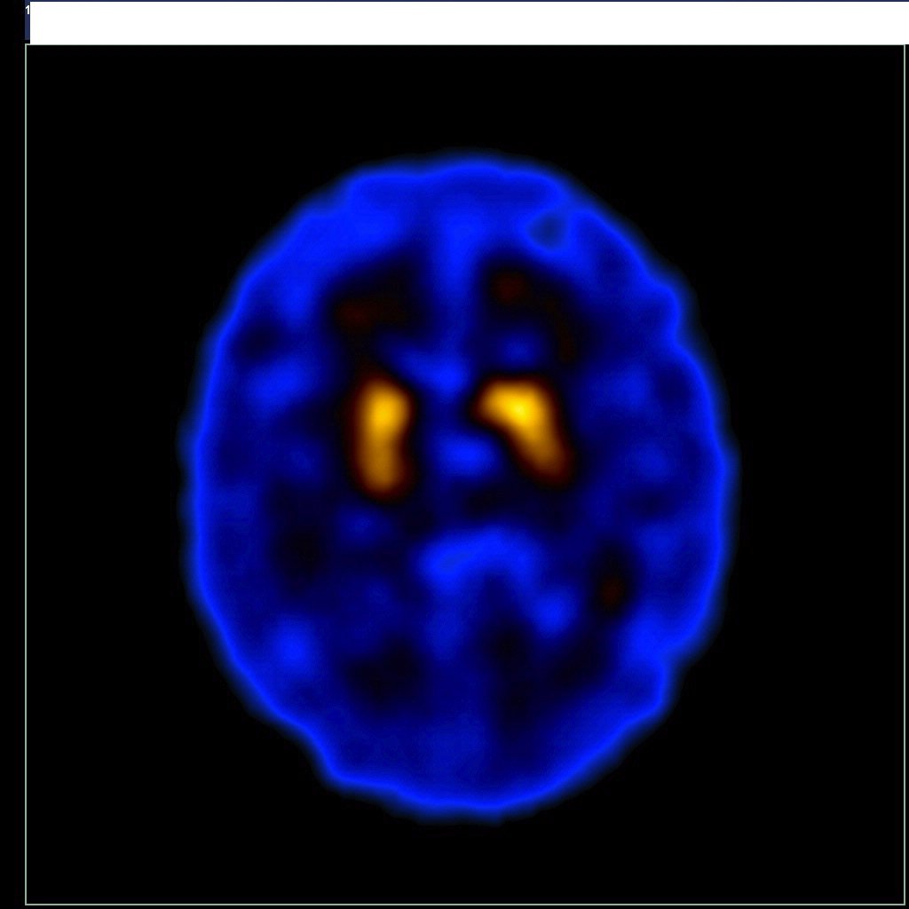 UDDO realiza exame que auxilia no diagnóstico do Mal de Parkinson