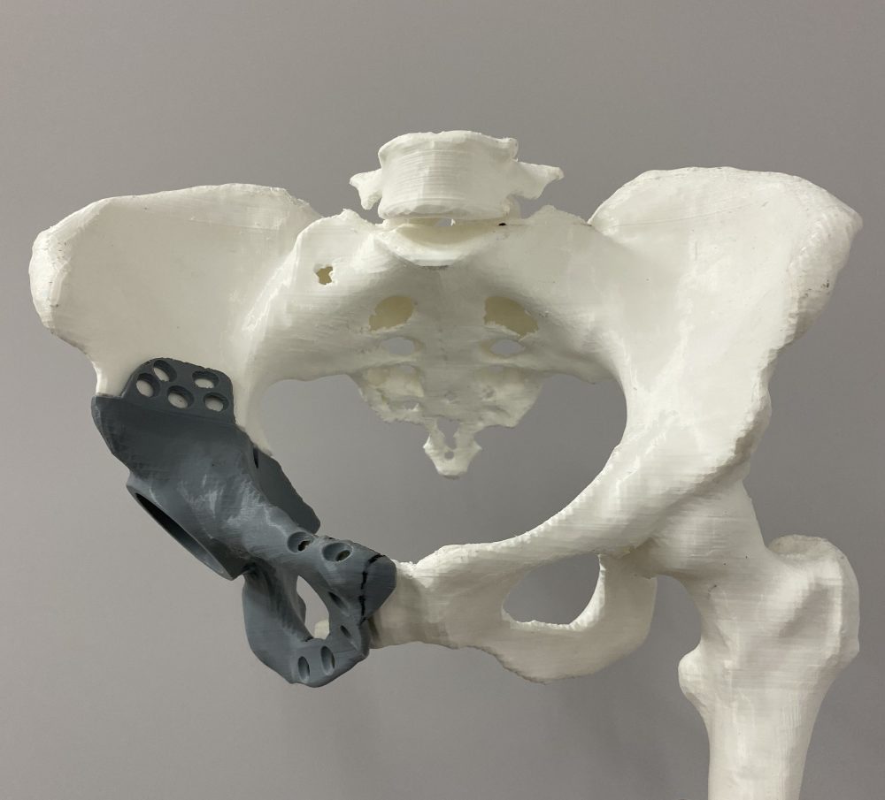 Hospital Santa Paula realiza cirurgia inédita de bacia com tecnologia 3D