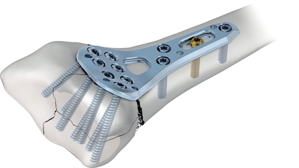 Novas Placas Medartis trazem inovação na fixação de fraturas