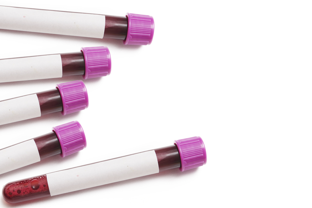 AbbVie estuda o Venetoclax no tratamento de Leucemia Linfocítica Crônica