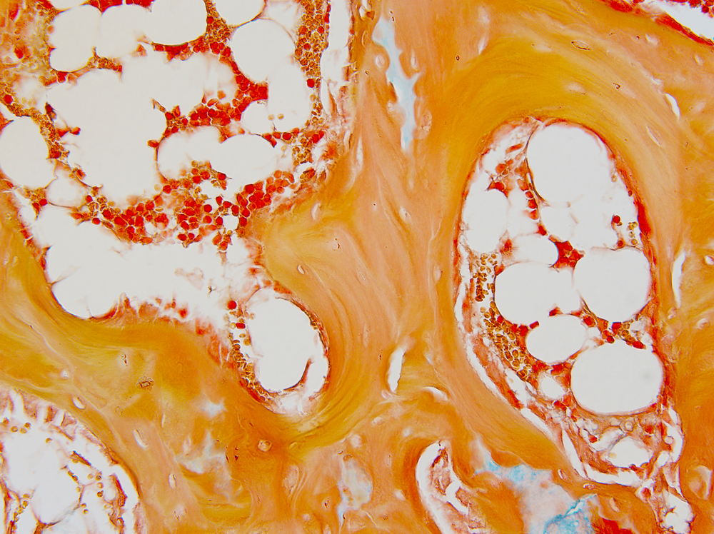 Transplante de Medula Óssea no Brasil