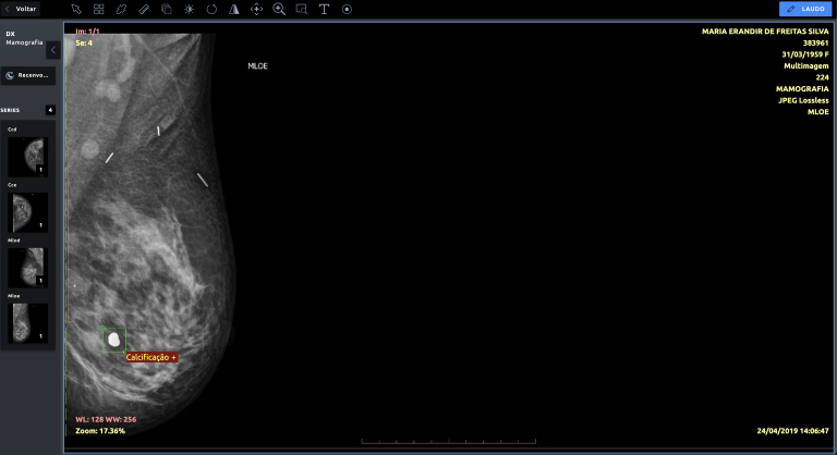 Primeira Inteligência Artificial para mamografia do Brasil foi desenvolvida no Ceará com investimento nacional