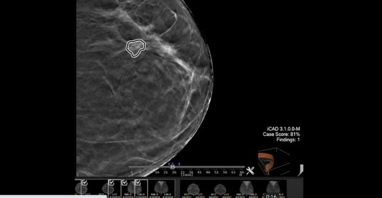 Inteligência artificial da NVIDIA ajuda pesquisadores e hospitais na luta contra o câncer