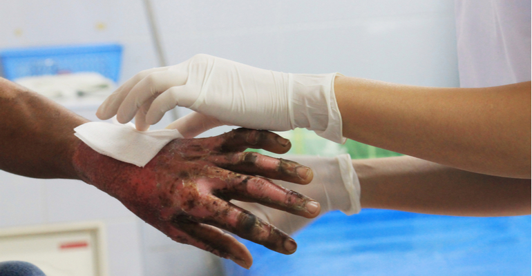 Pilar Hospital Implementa Centro de Tratamento de Queimados