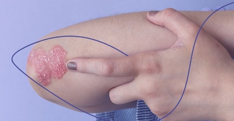 DB Molecular disponibiliza novo teste PCR para o diagnóstico da hanseníase