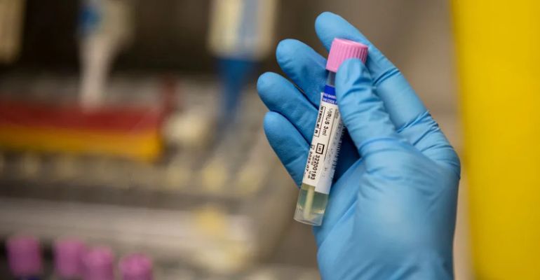 Varíola dos macacos: Grupo Sabin desenvolve exame para diagnóstico da doença