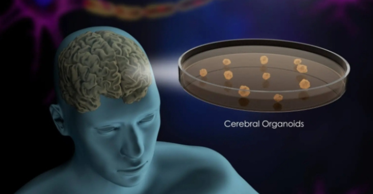 “Mini cérebros” revelam novas descobertas sobre o autismo
