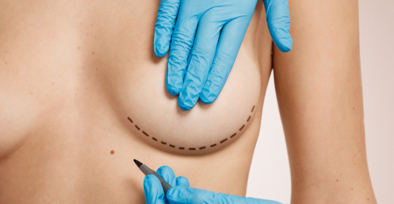 Santa Casa de Araçatuba implementa reconstrução mamária