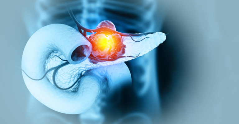 Metodologia inédita no Brasil permite diagnóstico em tempo recorde para câncer de pâncreas.png