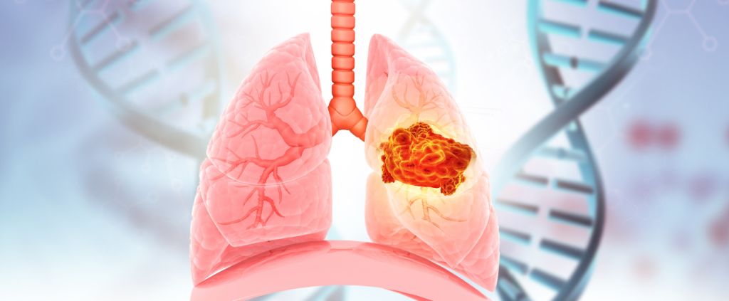 ANS abre Consulta Pública para avaliar nova terapia-alvo para câncer de pulmão