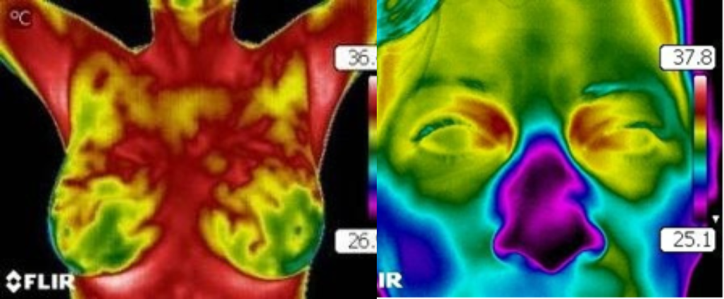 Pesquisa avalia uso da termografia com IA para fortalecer rastreamento do câncer de mama